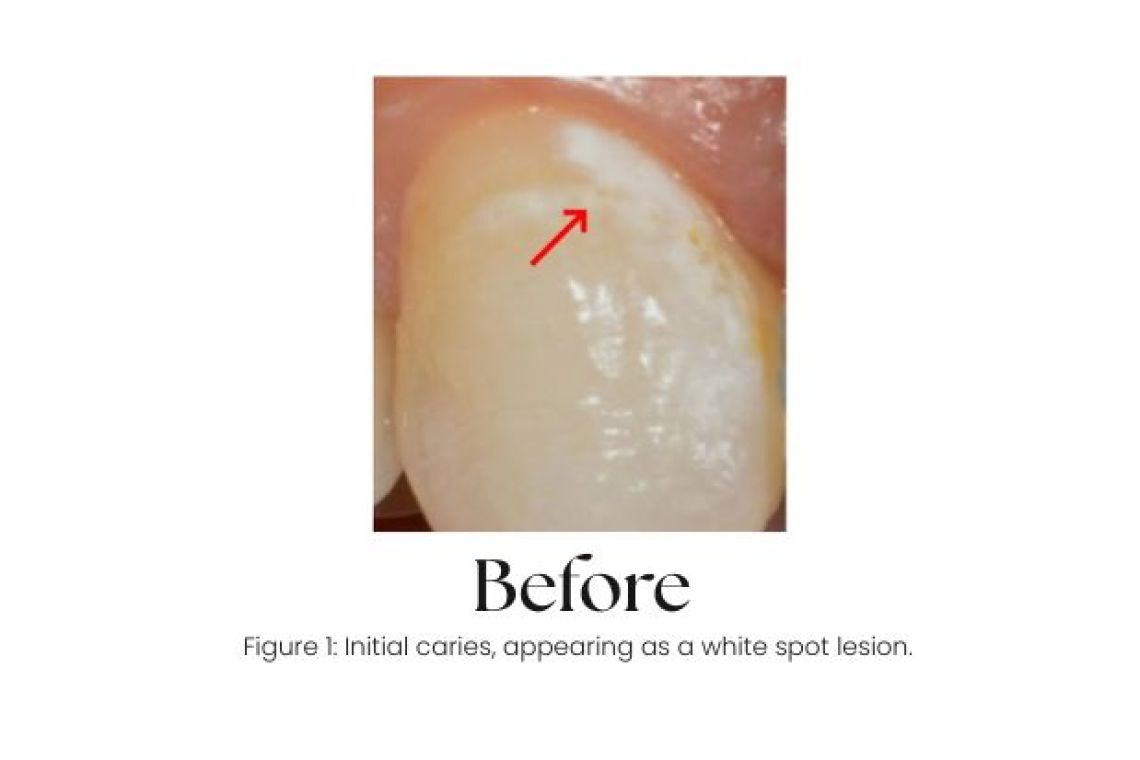 Close-up of a front tooth with a chalky white spot lesion, an early sign of enamel demineralisation, before Curodont Repair treatment